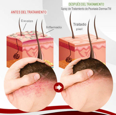 Spray Alivio Psoriasis Kolmax™ – Calma la Picazón, Descamación y Restaura tu Piel en Días 🌿✨