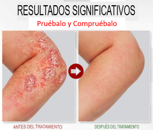 Spray Alivio Psoriasis Kolmax™ – Calma la Picazón, Descamación y Restaura tu Piel en Días 🌿✨